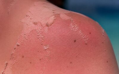 Cinci arsuri solare pot dubla riscul de melanom, avertizează medicii