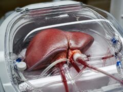 O procedură nouă ar putea aduce încă 150 de transplanturi de ficat pe an în Marea Britanie